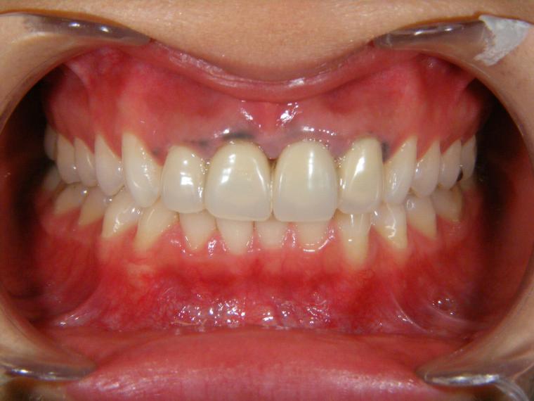 歯肉の色素沈着ですが、原因は不適切な合金などの歯への装着が多い。被せものを変えるだけでなく、歯肉をレーザーで取ることは可能です。