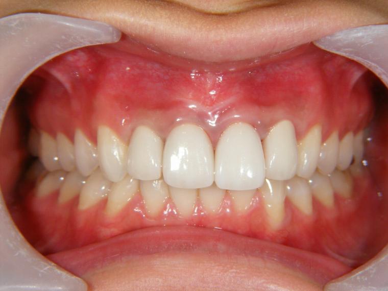 歯肉の色素沈着ですが、原因は不適切な合金などの歯への装着が多い。被せものを変えるだけでなく、歯肉をレーザーで取ることは可能です。