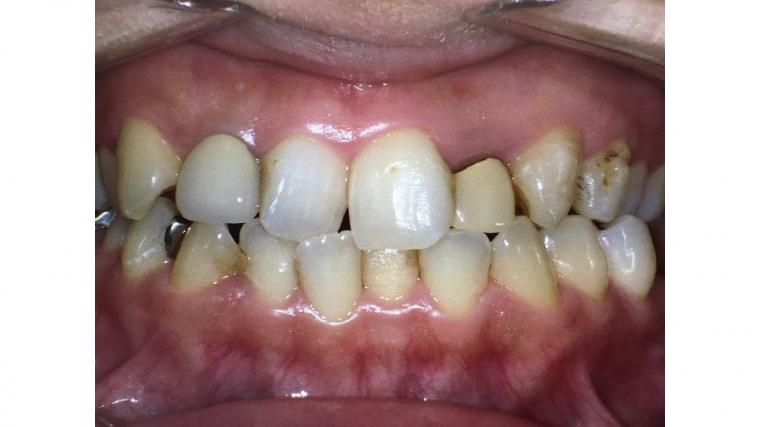 上顎前歯部の印象