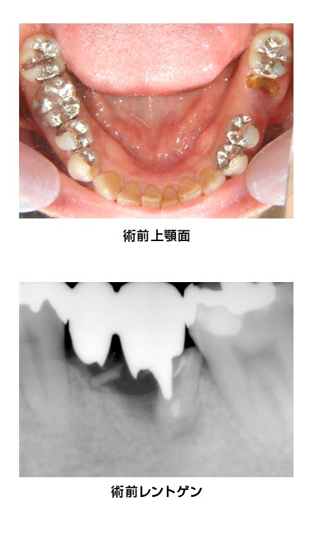 下顎臼歯・抜歯即時　治療前