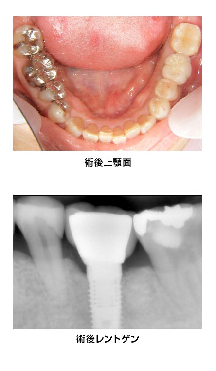 下顎臼歯・抜歯即時　治療後