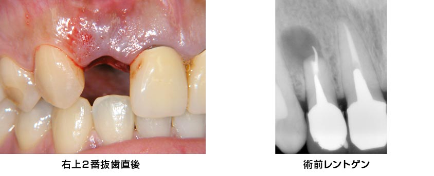 前歯部・右上2・抜歯即時　治療前