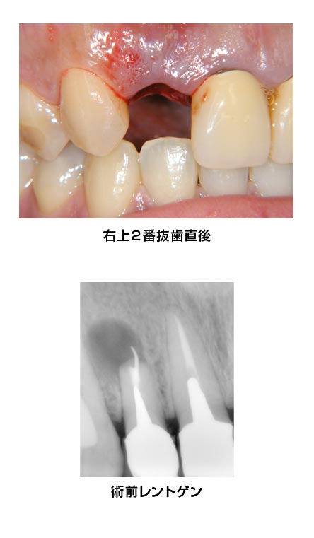 前歯部・右上2・抜歯即時　治療前