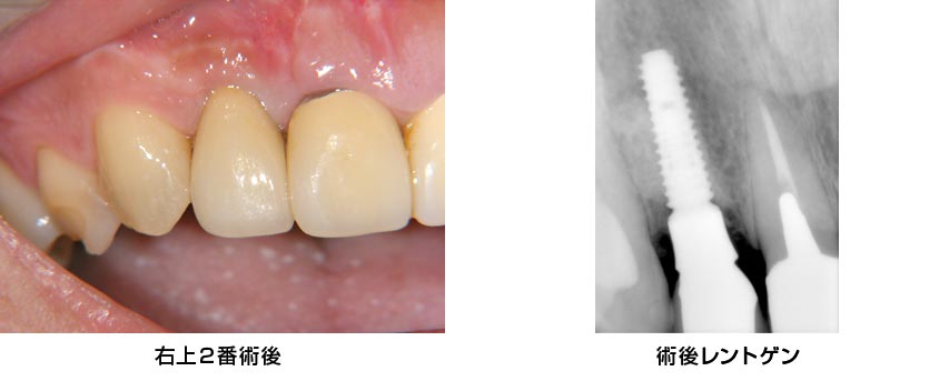 前歯部・右上2・抜歯即時　治療後