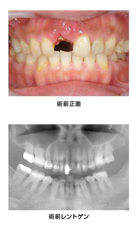 前歯部・右上1・抜歯即時　治療前