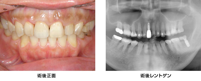 前歯部・右上1・抜歯即時　治療後