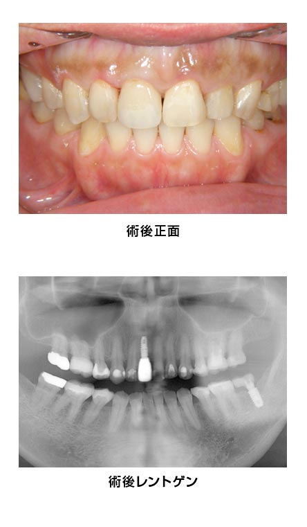 前歯部・右上1・抜歯即時　治療後